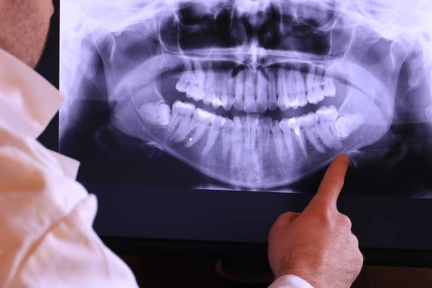 Best Emergency Treatment for Dental Infections or Abscesses in Woodworth, LA
