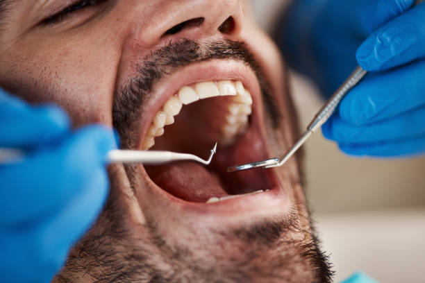 Best Emergency Root Canal Treatment in Woodworth, LA