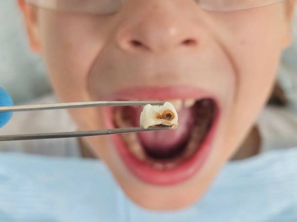 Best Emergency Denture Repair in Woodworth, LA